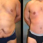 Top Three Procedures to Lose Tummy Fat