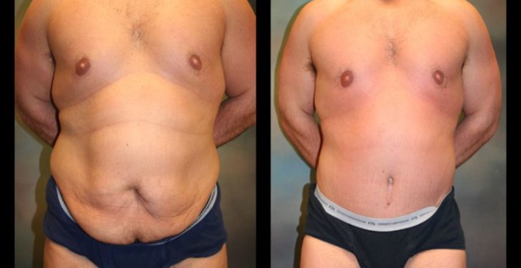 Top Three Procedures to Lose Tummy Fat