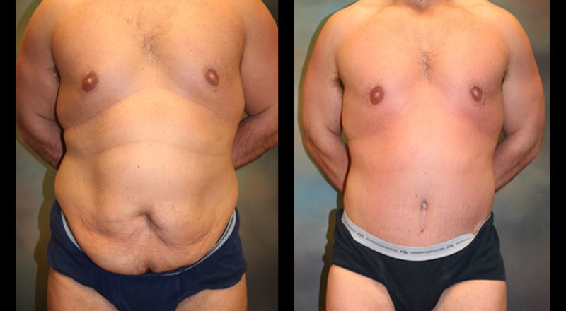 Top Three Procedures to Lose Tummy Fat