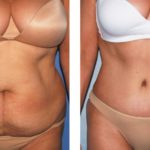 Primary Limits on Tummy Tuck