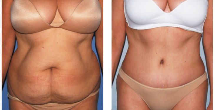 Primary Limits on Tummy Tuck