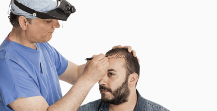 A Single Hair Transplant Session for Achieving the Best Cosmetic Outcomes