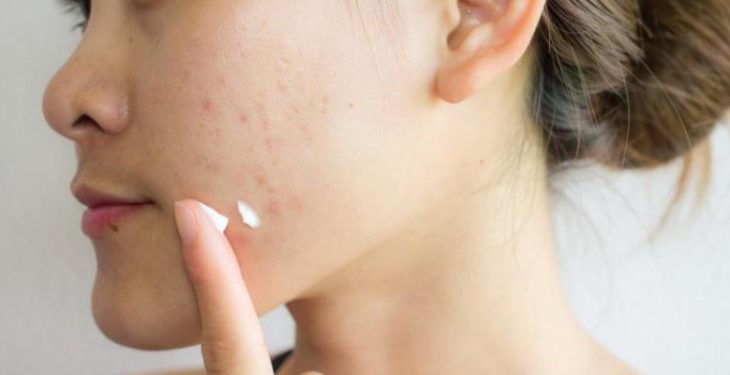 Causes And Cure Of Acne Scars