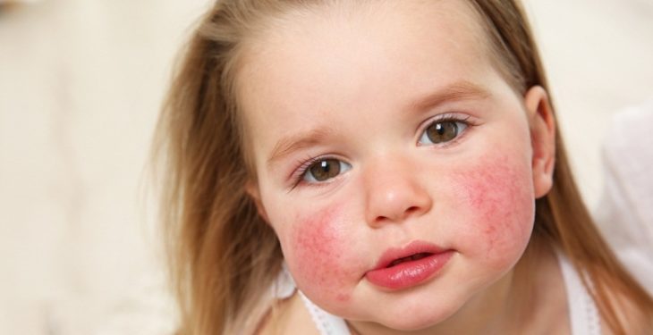 Yeast Infection In Young Children